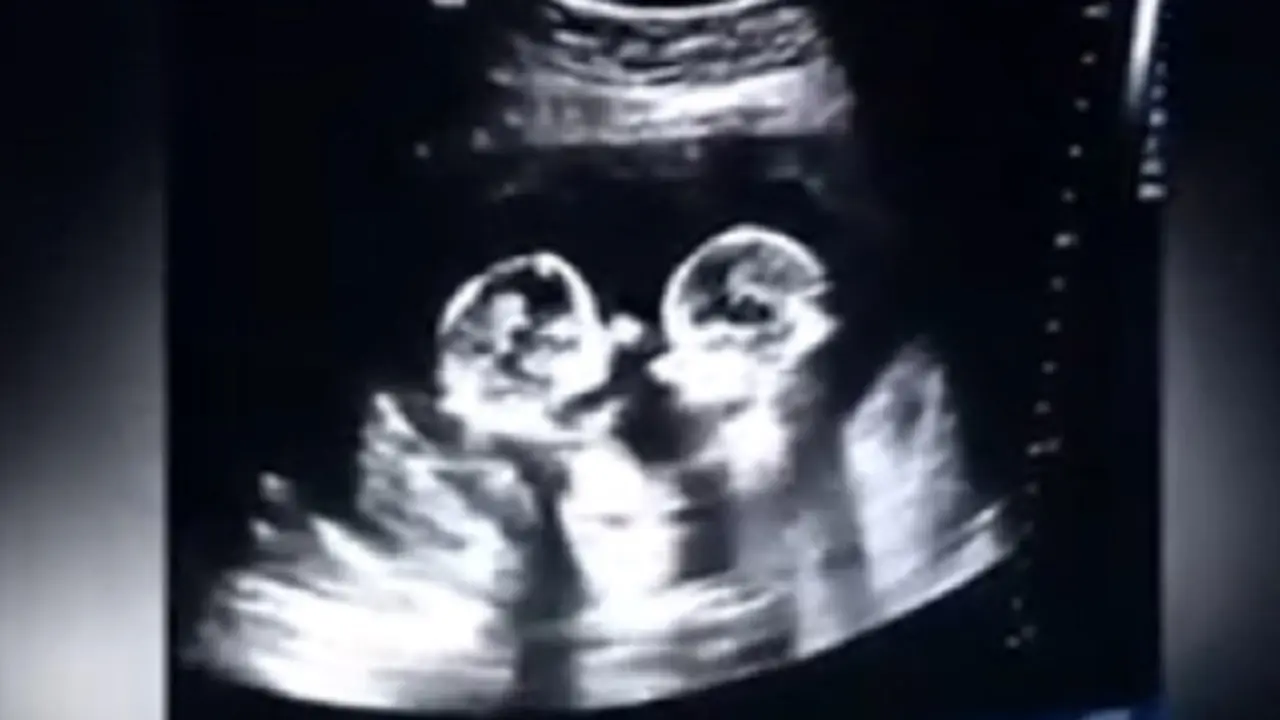 Viral, Rekaman USG Bayi Kembar Bertengkar dalam Rahim