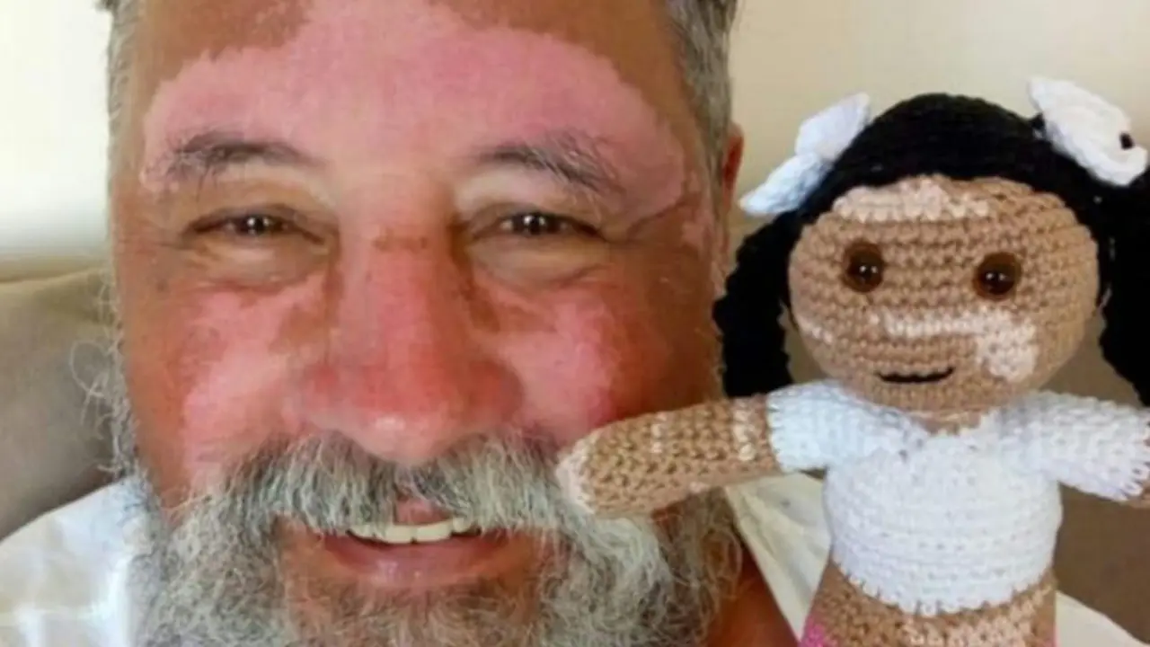 Meningkatkan PD Anak-Anak dengan Vitiligo, Pria Ini Buat Boneka Rajut Unik