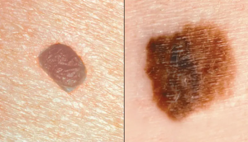 Perhatikan tanda yang muncul pada kulit. Jika tidak simetris tanda tersebut bisa dianggap sebagai kanker kulit. Credit: Cancer Network
