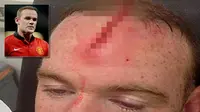Duh, Horornya Cedera Kepala Wayne Rooney