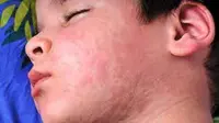 Reaksi alergi pada kulit anak