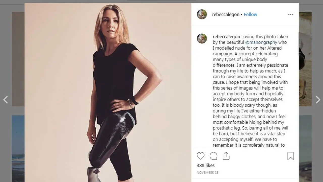 Rebecca Legon, wanita disabilitas asal Inggris yang kini bisa menerima keadaan dirinya