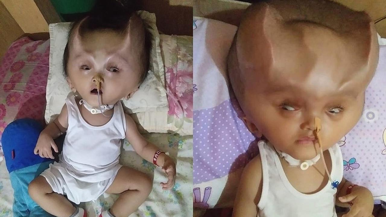 Kondisi Langka Buat Bocah Ini Seperti Punya Tanduk Setan