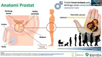 Kanker Prostat. Foto: Tangkapan layar presentasi Dr. Agus Rizal Ardy, Sp.U(K), Ph.D, youtube RS Bunda (28/9/2020).