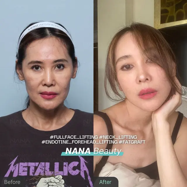 10 Potret Jeremy dan Ina Thomas Jalani Operasi Plastik di Korea, Jadi Sorotan