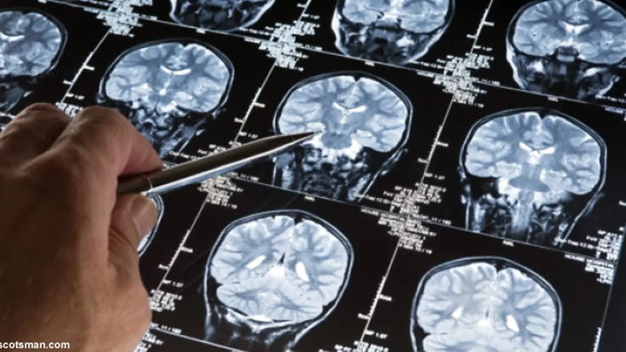 epilepsi-autisme-130521c.jpg