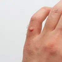 ilustrasi kutil (sumber: Freepik)