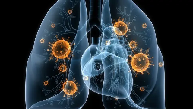 Penyebab Penyakit Pneumonia