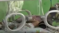 Bayi kembar siam di Tasikmalaya, terlahir di rumah tanpa bantuan medis.