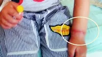 Tangan Longlong merah dan bengkak akibat gelang karet yang dipakainya sejak usia satu tahun. (Foto: Daily Mail)