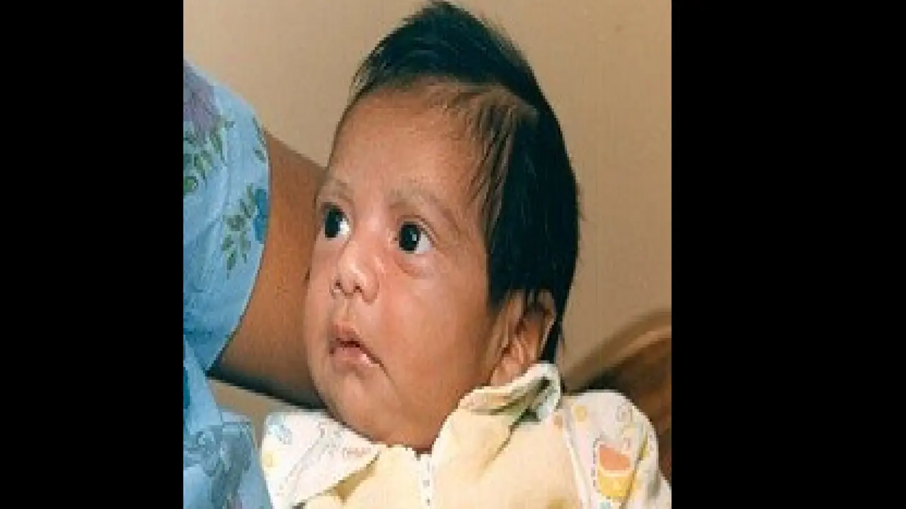 Baby Fae yang mendapatkan transplantasi dari jantung primata babon.