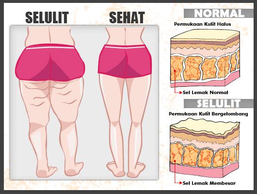 Inilah Cara Ampuh Atasi Selulit Beauty Fimela Com