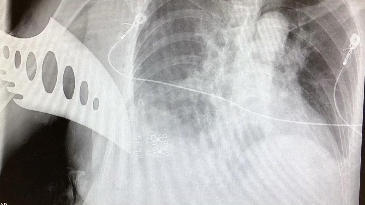 Seorang nenek Asia ditusuk di jalan San Fransisco. Pisau pelaku tertancap di perut korban.