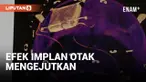 Remaja Inggris berusia 13 tahun, Oran Knowlson, menjadi anak pertama di dunia yang menerima implan otak untuk mengontrol kejang epilepsi. Sebelum operasi implan, Oran mengalami 300 kejang per hari sejak usia tiga tahun.