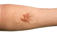 Keloid / Sumber: iStockphoto