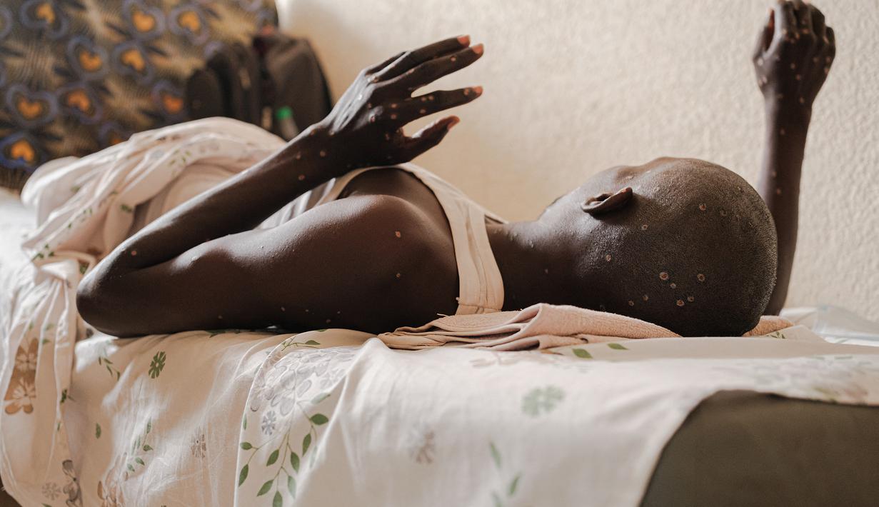 Tiga kasus mpox terdeteksi di Burundi pada akhir Juli, dan kementerian kesehatan melaporkan 153 kasus yang terkonfirmasi pada tanggal 18 Agustus. (Tchandrou NITANGA / AFP)