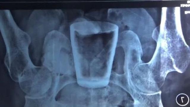 Hasil rontgen nampak gelas kaca bersarang di perut pria asal Jember. (Istimewa)