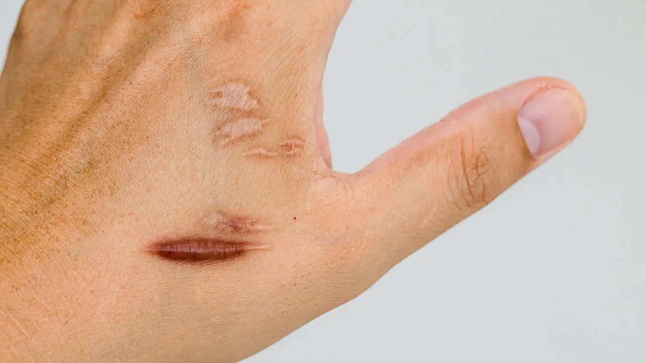 Cara Menghilangkan Keloid