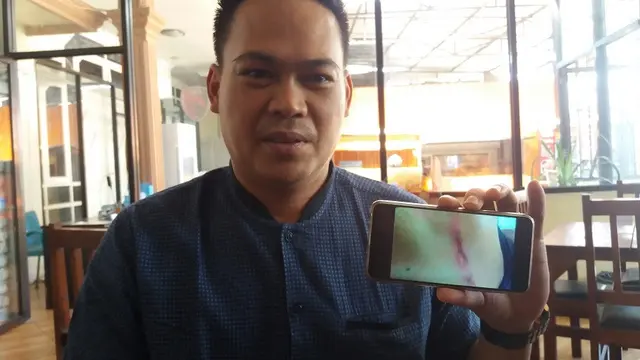 Aktivis anti korupsi yang jadi korban pengeroyokan memperlihatkan bukti luka di bagian punggungnya usai dikeroyok (Liputan6.com/ Eka Hakim)
