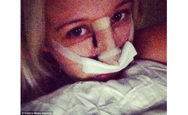 Kondisi setelah operasi plastik hidung | Foto: copyright dailymail.co.uk