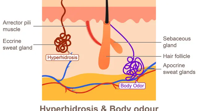 Ilustrasi hiperhidrosis