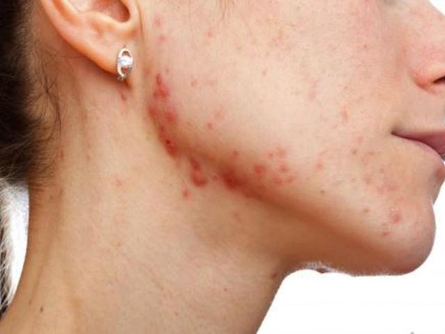 4 Tips Menghilangkan Jerawat Yang Radang Health Liputan6 Com