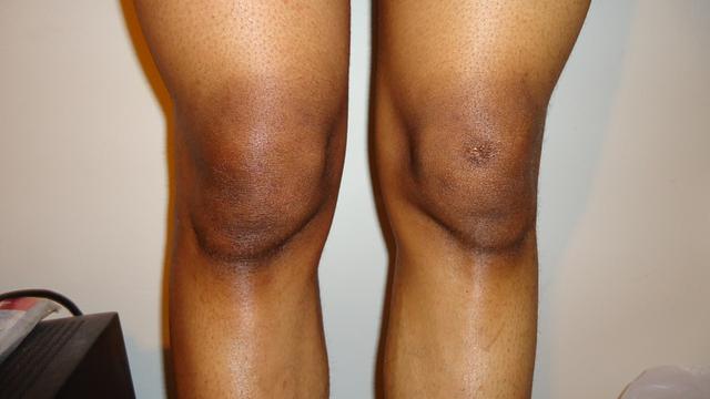 10 Cara Alami Samarkan Hitam di Lutut - Fashion & Beauty Liputan6.com