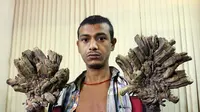 Seorang pria di Bangladesh dijuluki manusia akar karena memiliki banyak kutil di tangan dan kakinya. 