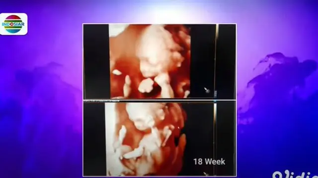 6 Potret Lesty Kejora Pamer Foto USG, Kini Usia Kandungan Sudah 6 Bulan
