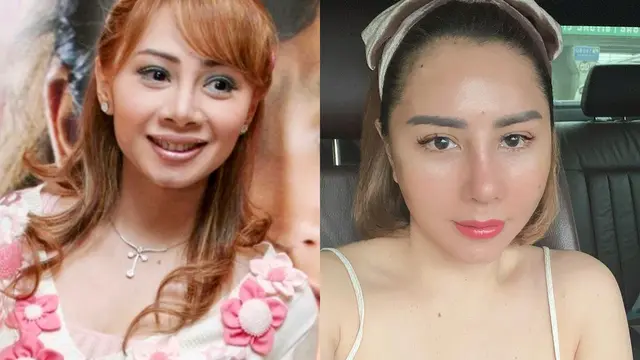 Transformasi Femmy Permatasari dari Dulu Hingga Baru Selesai Operasi Plastik di Korea