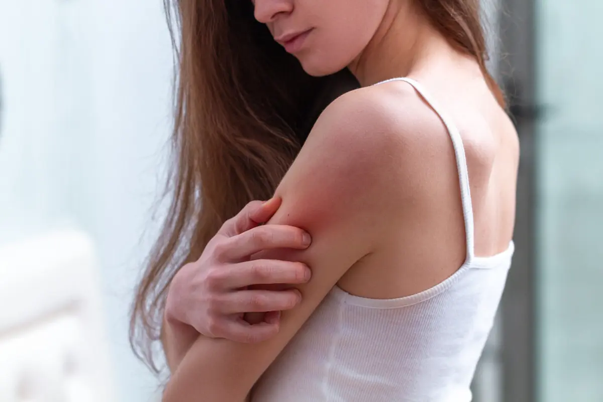 Ilustrasi psoriasis