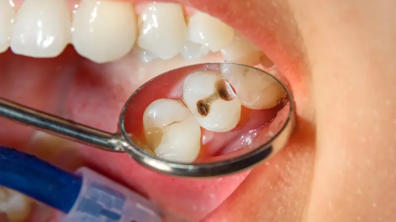 Awas! Ini Berbagai Kebiasaan yang Bisa Berisiko Menyebabkan Gigi Berlubang