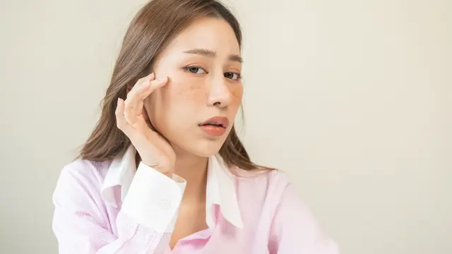 Jerawat pada Ibu Hamil, Awas Penanganan Kurang Tepat! Intip Penyebab dan Cara Aman Mengatasinya