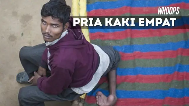 WHOOPS: Kisah Miris Pria Berkaki 4 yang Menyita Perhatian Netizen