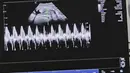 Dalam video singkatnya Icha juga menunjukan suara detak calon bayi dalam kandungannya. [Foto: Instagram/ichasoebandono]