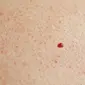Bintik merah ini biasa disebut angioma dan merupakan tumor jinak pembuluh darah. Apa yang harus kita lakukan?