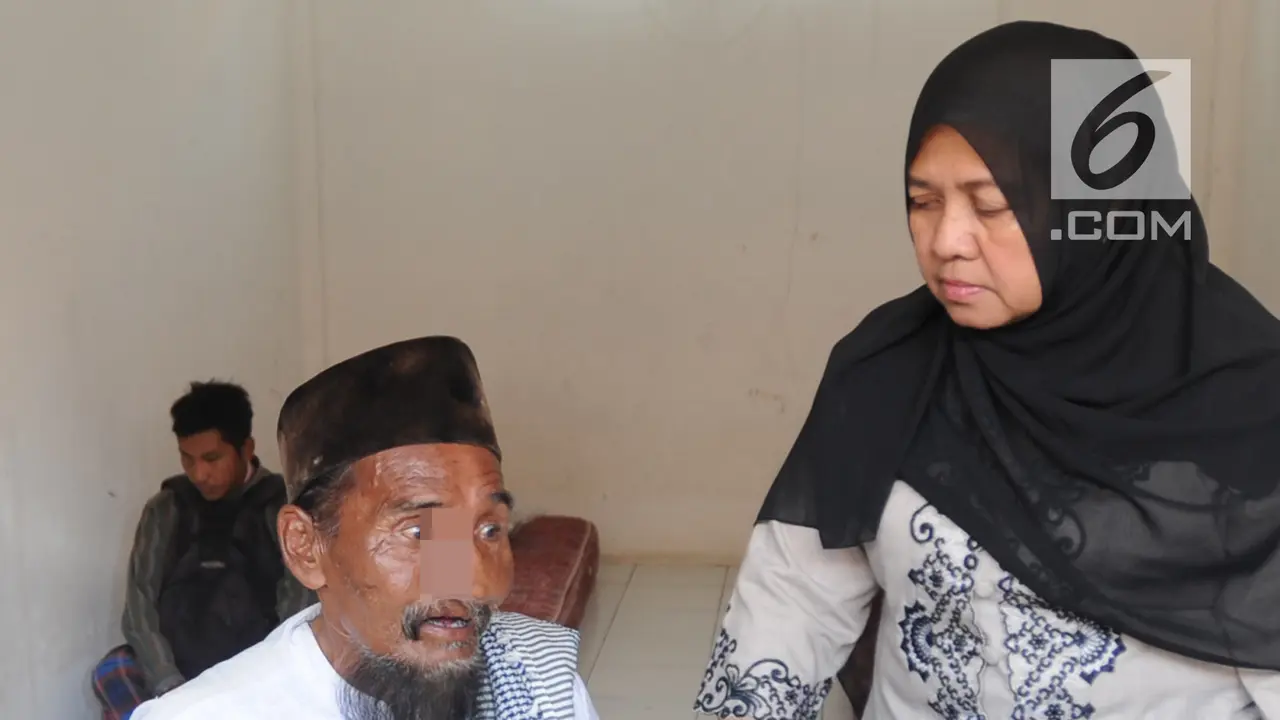 Viral Bermobil, Satpol PP Amankan Pengemis Tanpa Hidung di Bogor