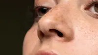 Mengapa Flek Hitam Bisa Muncul di Wajah?