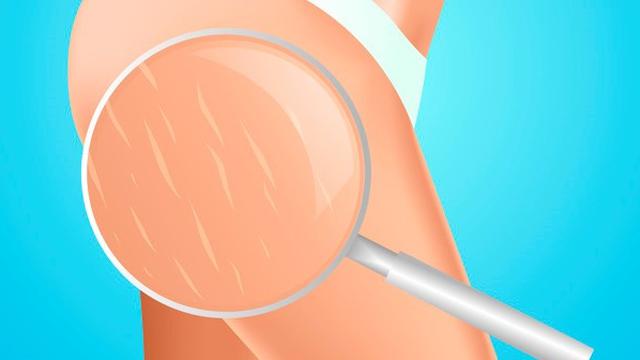 Ilustrasi manfaat kopi untuk kecantikan, mengatasi selulit