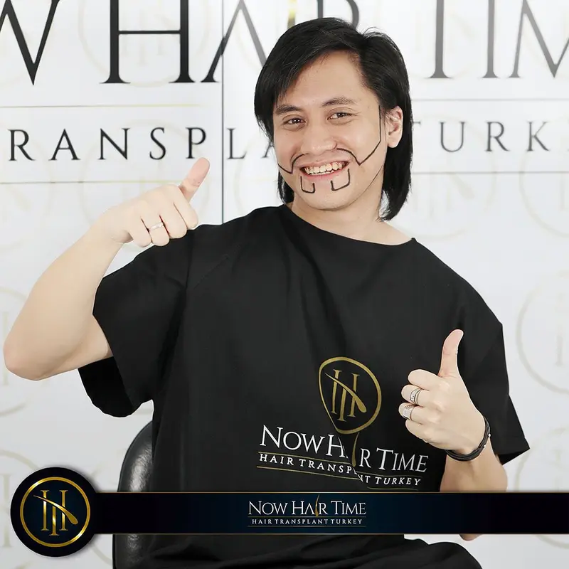 Potret Kevin Aprilio Jalani Transplantasi Rambut. (Sumber: Instagram/now.hairtime)