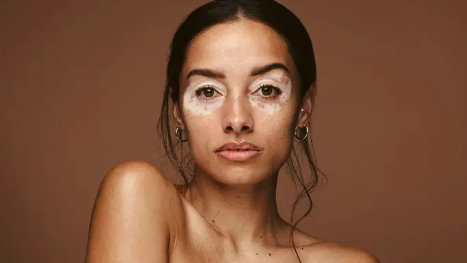 kulit vitiligo