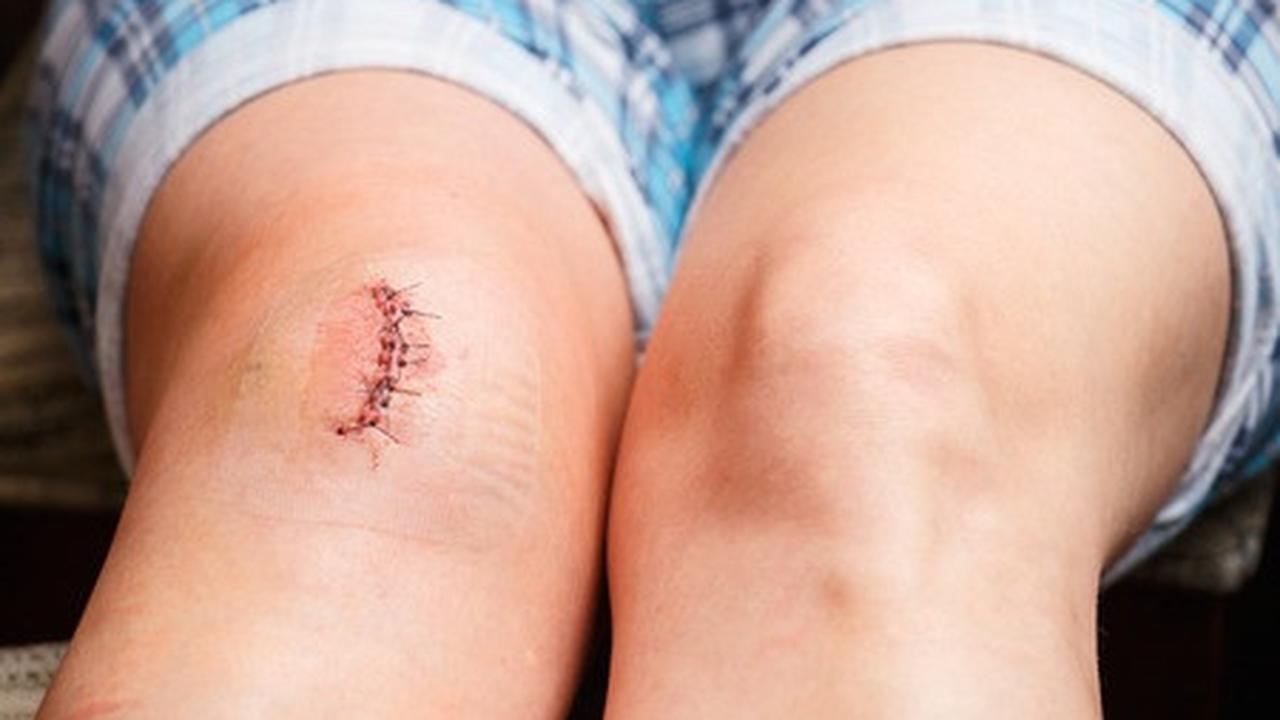 Pertolongan Pertama Bila Digigit Hewan Rabies, Perhatikan Langkah-Langkahnya