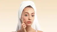 How to Get Rid of a Pimple Fast: 9 Home Remedies for Acne