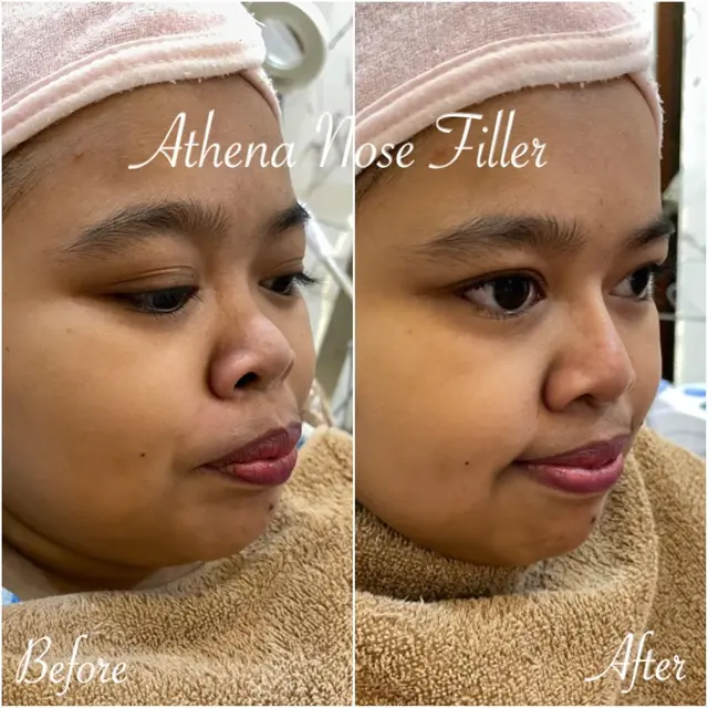 6 Potret Terbaru Kekeyi Setelah Filler Hidung, Tampil Beda