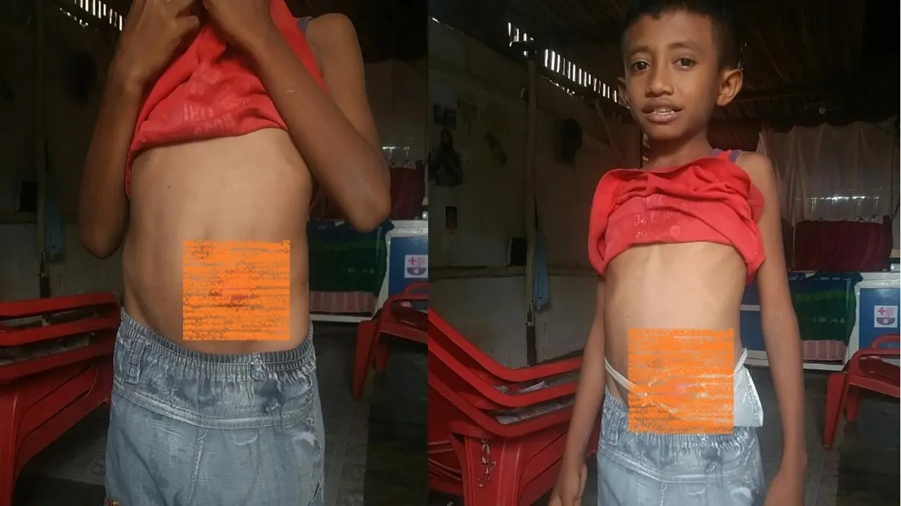 Terlahir tanpa anus
