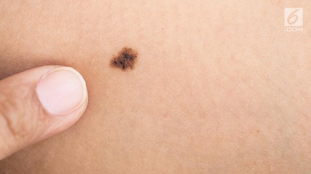 Potensi Penyebab Kanker Melanoma Bisa Dilihat dari Bentuk Tahi Lalat