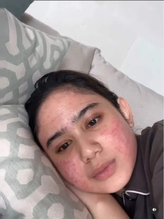 6 Potret Tissa Biani 4 tahun jadi pejuang jerawat, kerap nangis saat bercermin, ajarkan kesabaran