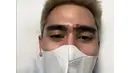 Verrell Bramasta alami luka sobek pada bagian alis dan dapat 20 jahitan. (Sumber: Instagram/bramastavrl)