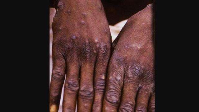 Monkeypox atau penyakit cacar monyet.