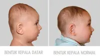 Ilustrasi: Bentuk Kepala Bayi